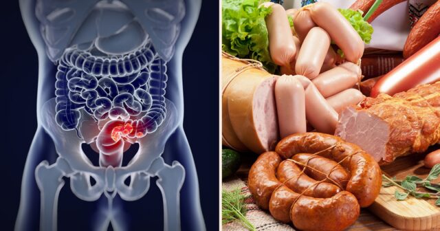 media-ultra-processed-foods-may-cause-colorectal-cancer-according-to-science