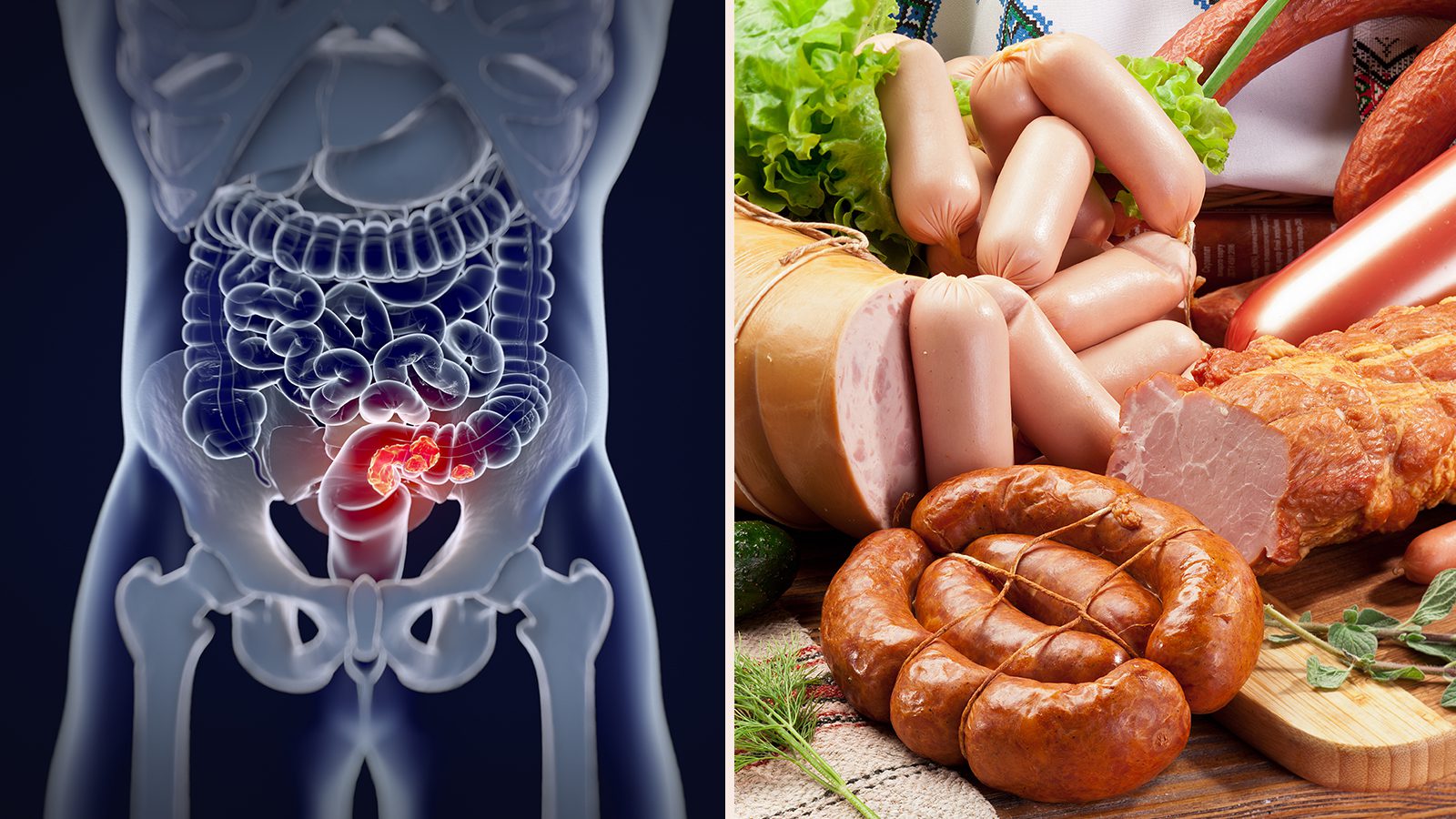 media-ultra-processed-foods-may-cause-colorectal-cancer-according-to-science